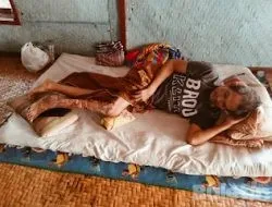 Yudi (50) Warga Desa Cibadak Cianjur Cianjur Terkena Tumor kulit Ganas Butuh Perhatian